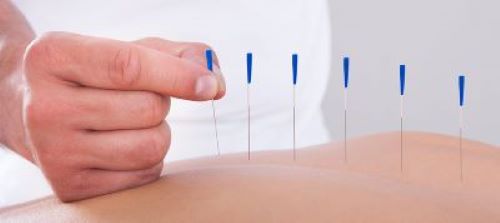 Agujas para Punción Seca y Acupuntura: Guía Completa para Profesionales